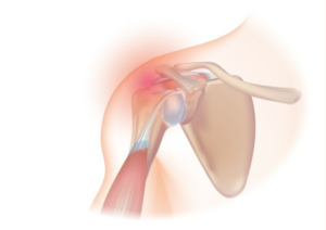 https://www.injurymap.com/diagnoses/rotator-cuff-syndrome